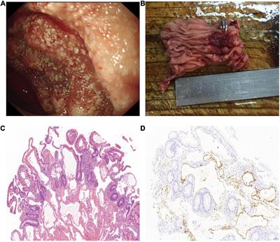 Clinical manifestation and treatment of small intestinal lymphangioma: A single center analysis of 15 cases